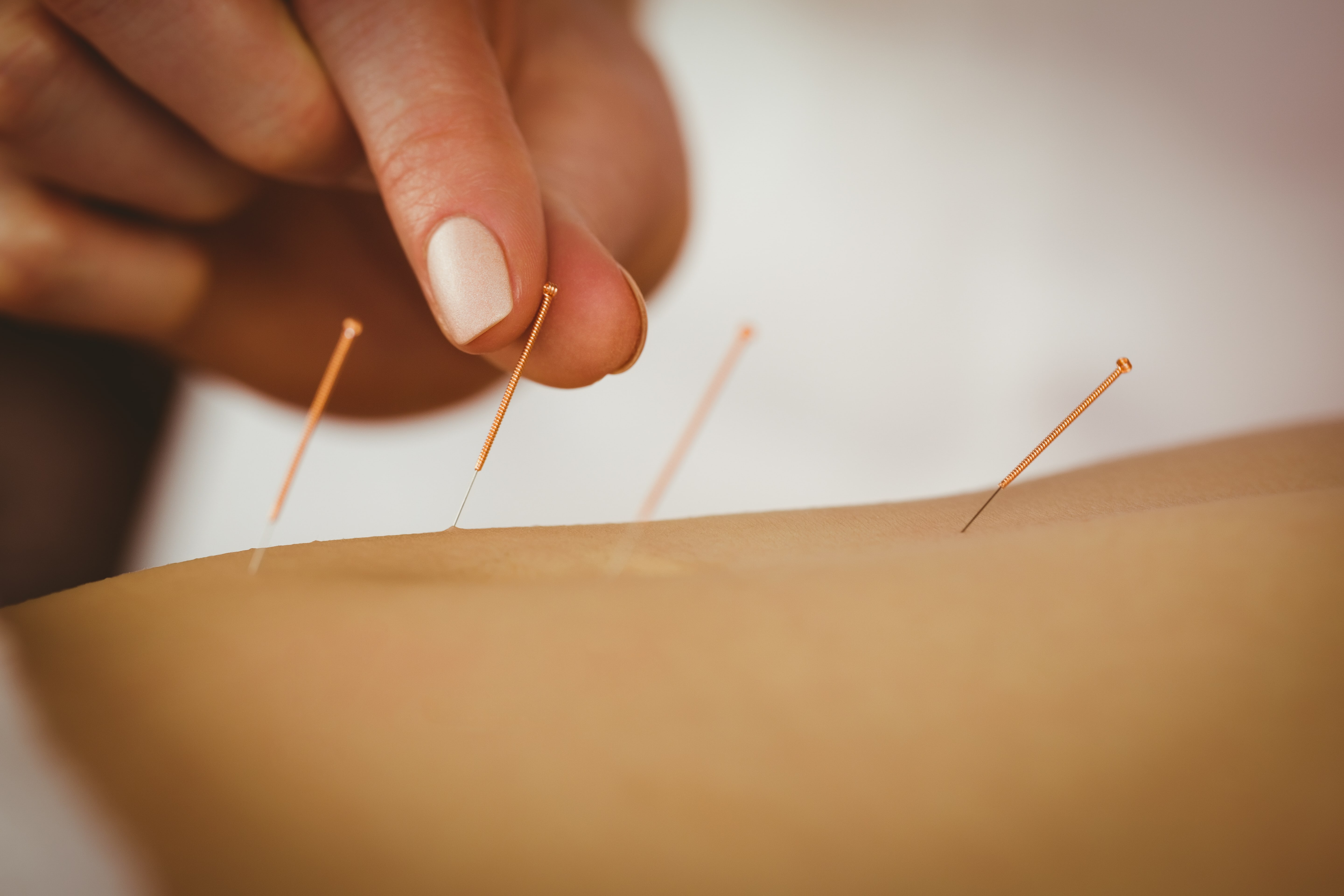 Acupuncture Hamilton Ohio