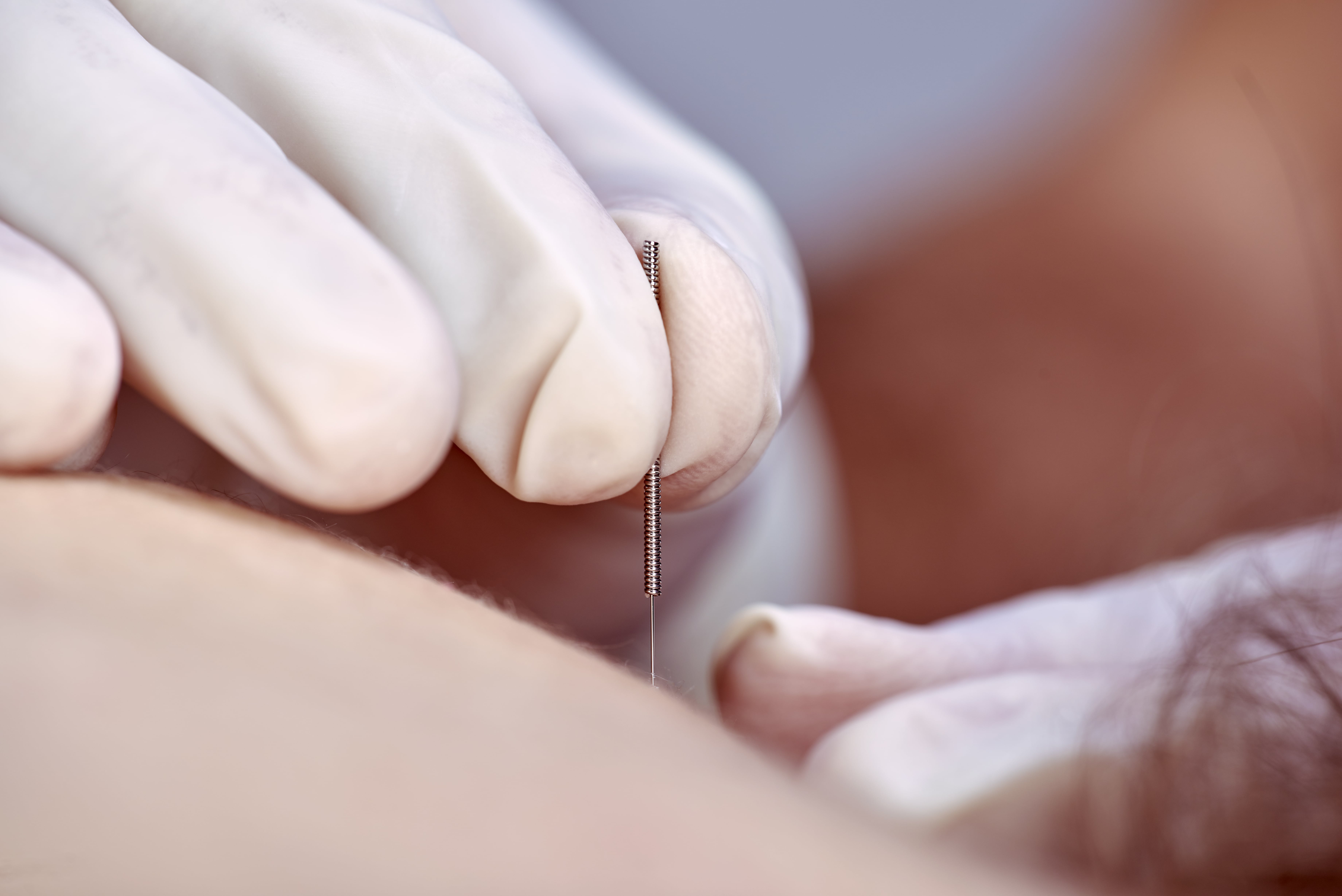 Dry Needling Hamilton Ohio, Fairfield Township